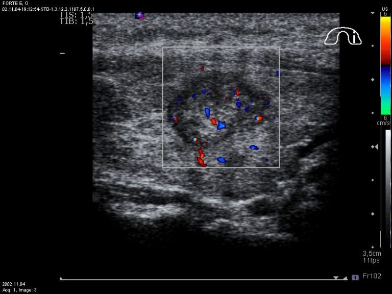 Tumore della Tiroide Dott. Fabio Maino